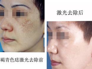 激光祛黄褐斑需要多少钱?