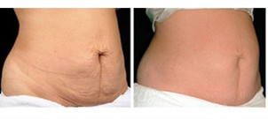 电波拉皮轻松祛除妊娠纹!