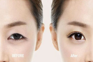 割双眼皮后要怎么护理?打开媚眼看世界