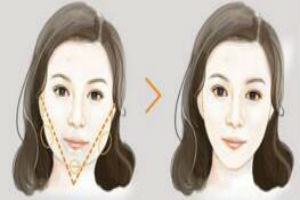 V脸塑形都有哪些优势呢?精致v脸,你也可以有