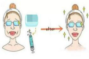 V脸塑形都有哪些优势呢?精致v脸,你也可以有