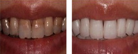 外因性色素牙美白前后对比图 外因性色素牙美白前后对比图