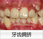 牙齿拥挤 牙齿拥挤