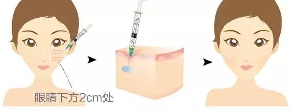 丰苹果肌的方法