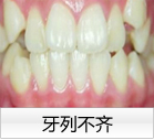 牙列不齐 牙列不齐