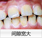 间隙宽大 间隙宽大