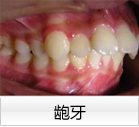 龅牙 龅牙